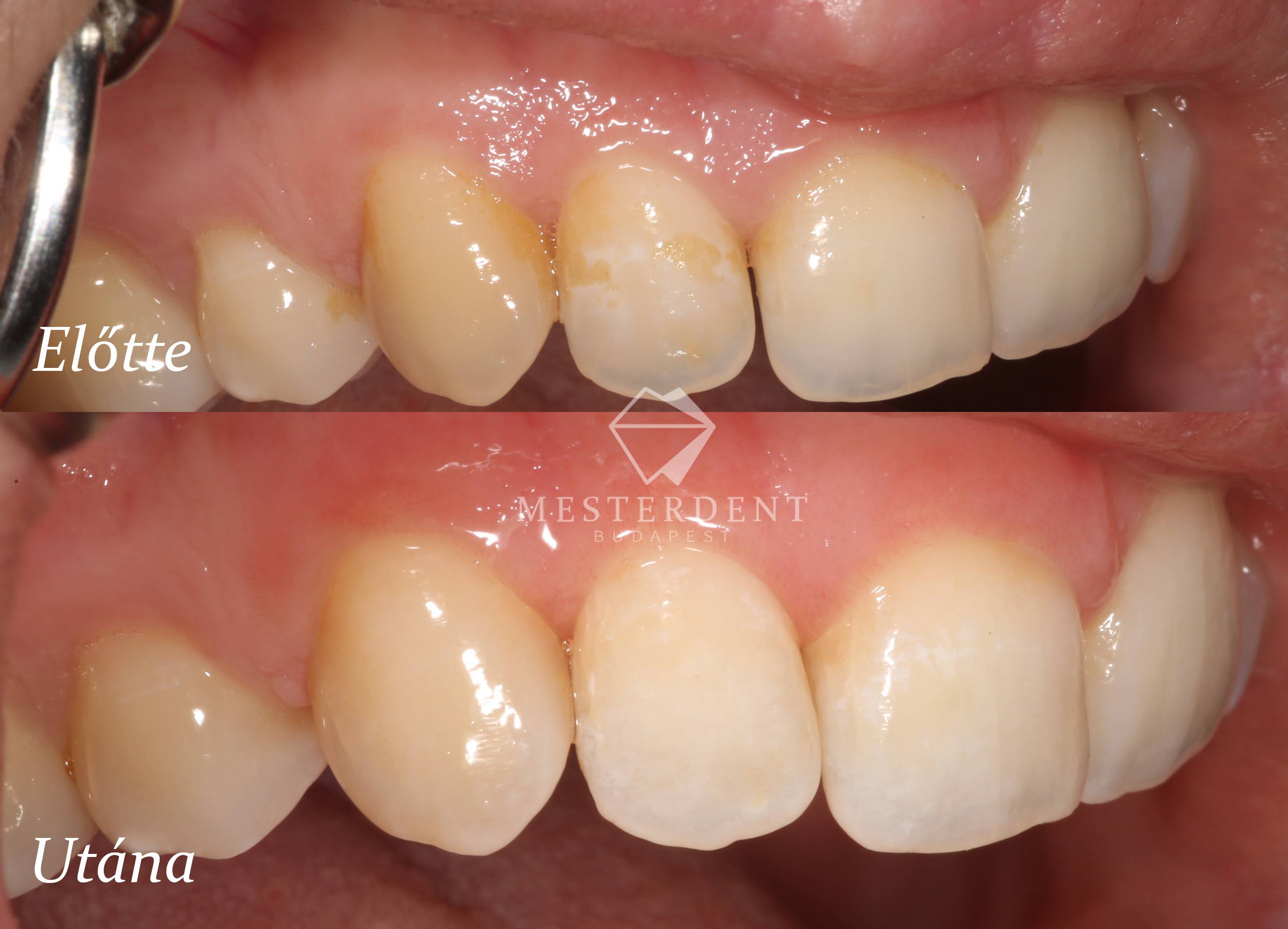 Fehér foltok a fogakon