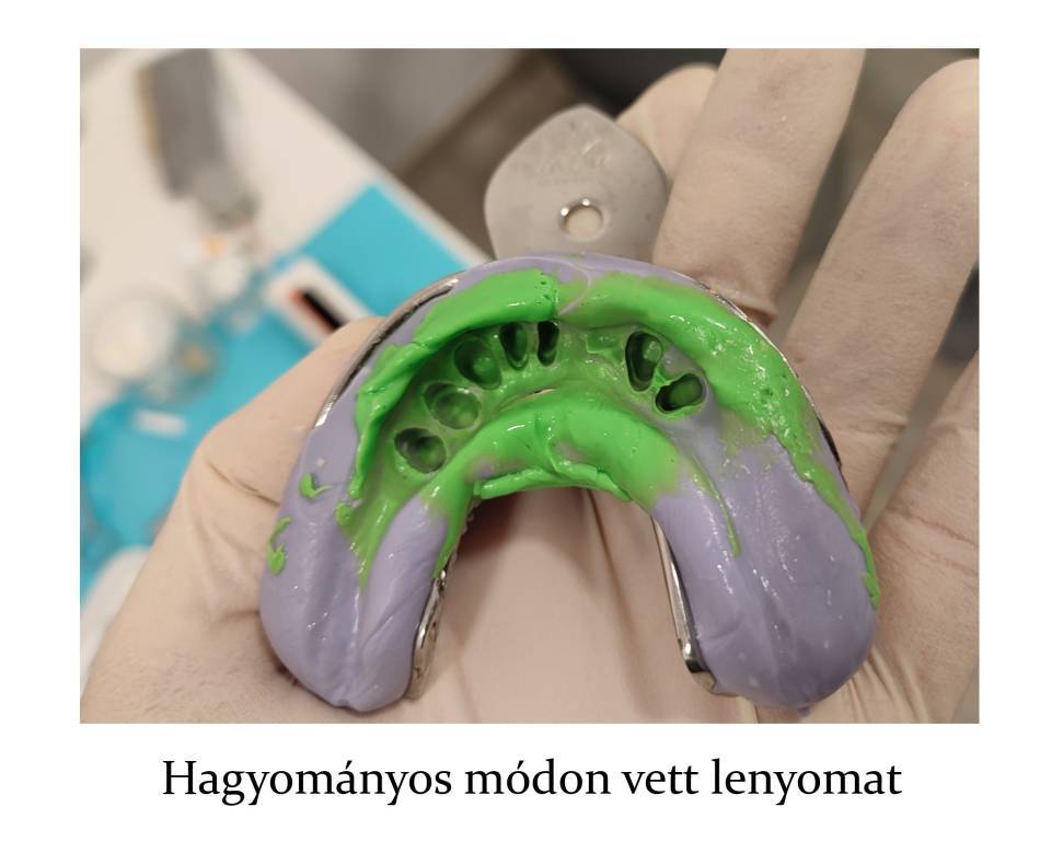 Digitális fogászat: intraorális szkenner a rendelőnkben