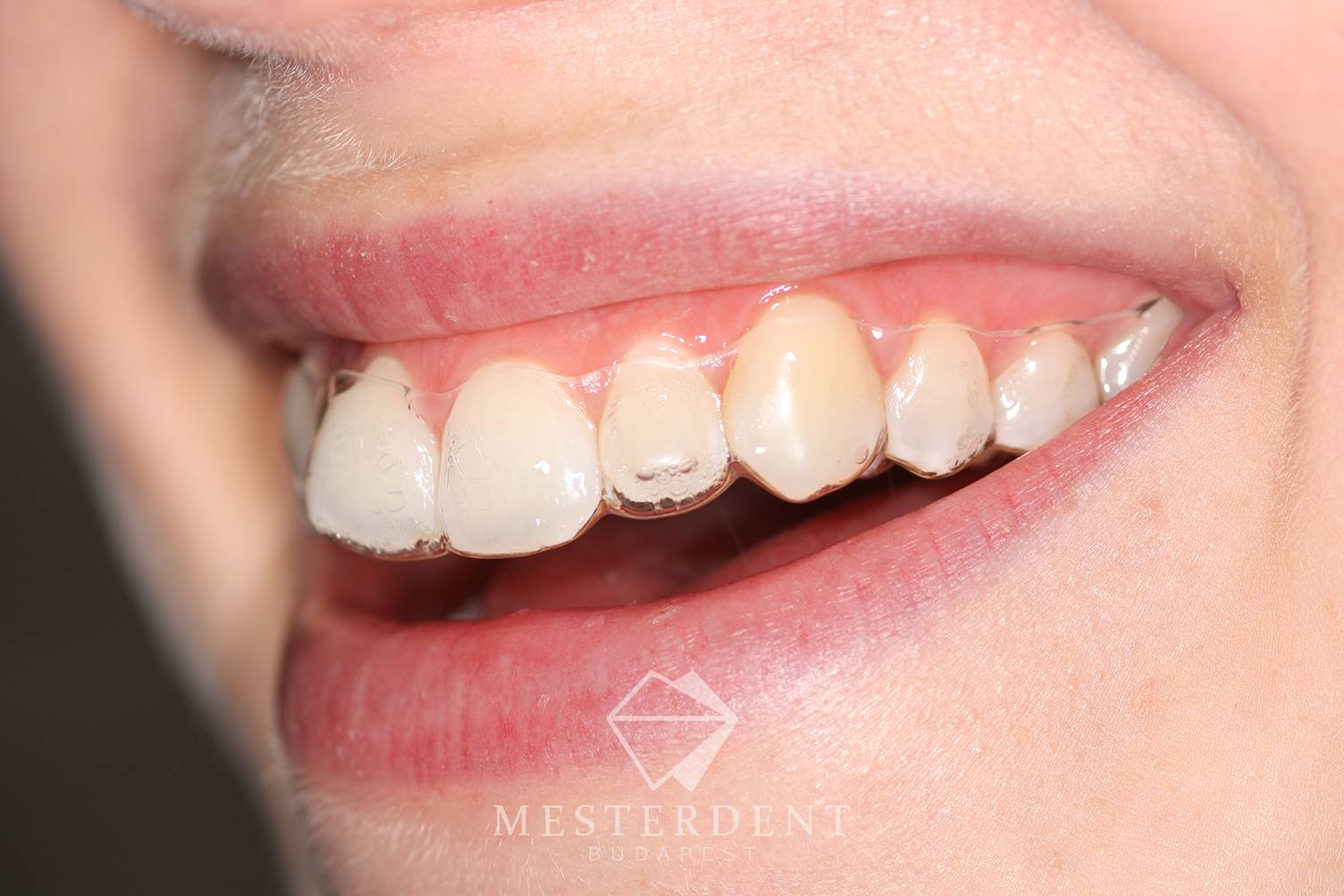 Láthatatlan fogszabályozás