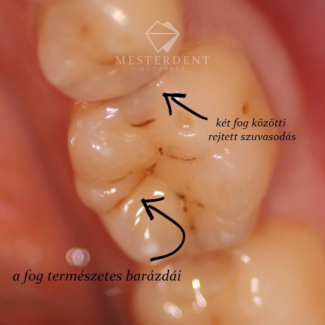 Fogszuvasodás - lyukas fogak kialakulásának oka, kezelése