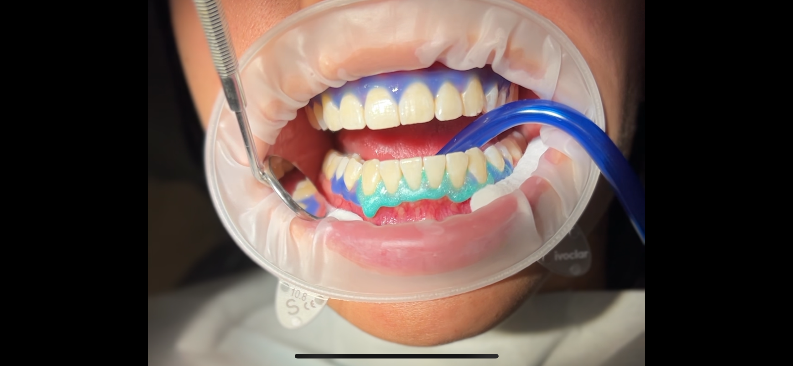 Lézeres fogfehérítés - előnyei, menete, tudnivalók