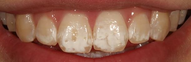 Mitől függ a tömések ára?