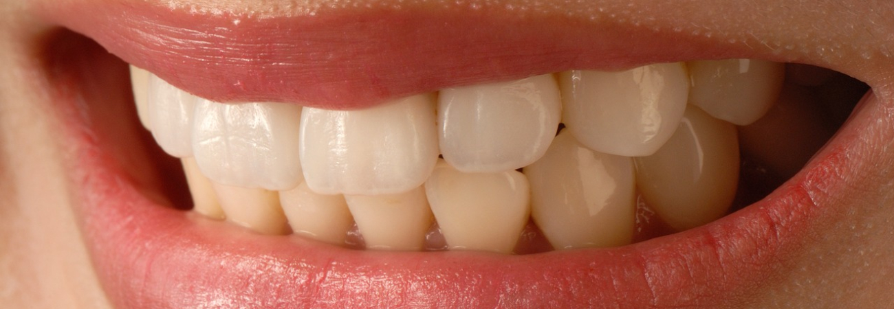 Porcelán héjak készítése rendelőnkben