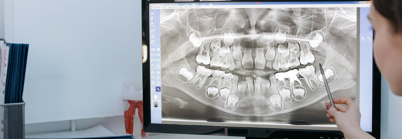 Miért nem kell félni a fogászati röntgenek okozta sugárterheléstől?