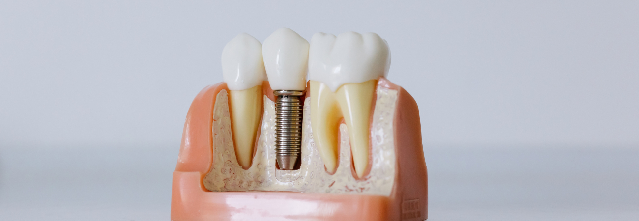 Mennyibe kerül az implantációs fogpótlás?